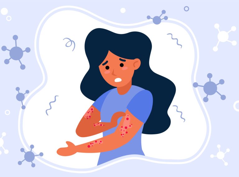 Person suffering from rush Person suffering from rush. Hives, fever, stress, chickenpox flat vector illustration. Illness, epidemics, virus concept for banner, website design or landing web page